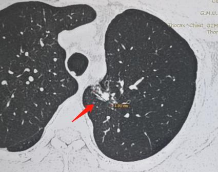 很多人拿到病理报告，看到“浸润性腺癌”这五个字，瞬间就陷入恐慌，觉得自己得了不治