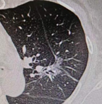 给大家分享一个特别的病例，这位65岁的女性患者，最近两个月，全身关节总是酸痛，而