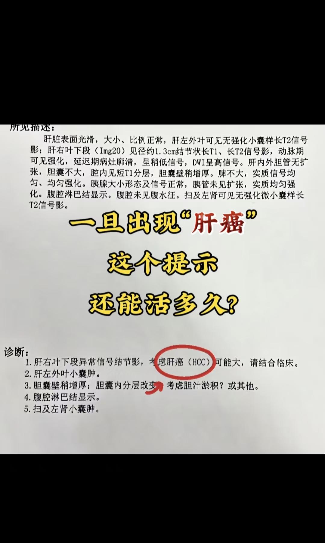 一旦出现肝癌这个提示，还能活多久？ 从医 20 年，我最怕见患者拿到肝...