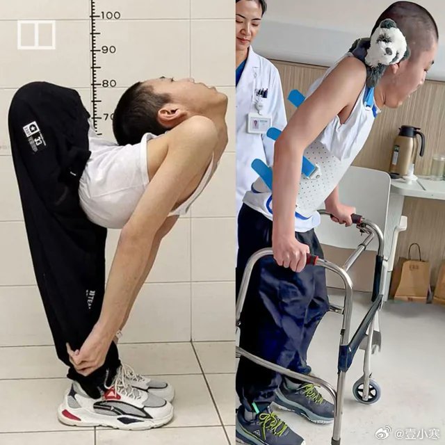 这也许就是医学的意义👍被称为“中国折叠男孩”的姜彦辰，在经历了四次复杂的手术后
