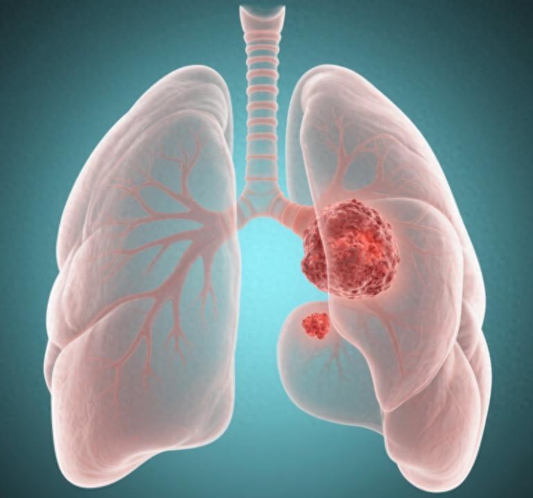 2021年，一位53岁的男性患者在确诊晚期非小细胞肺癌（NSCLC）后，陷入了深