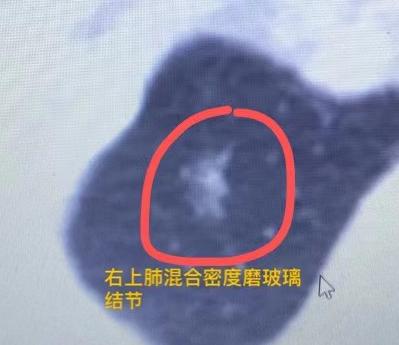 “观察两年都没变化的肺结节，这次我还是建议切除”！30岁的她拿着体检报告，再次走