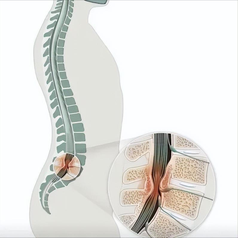 五大症状识破马尾神经损伤，出现一个就要立即就医！马尾神经损伤是神经外科的急症，