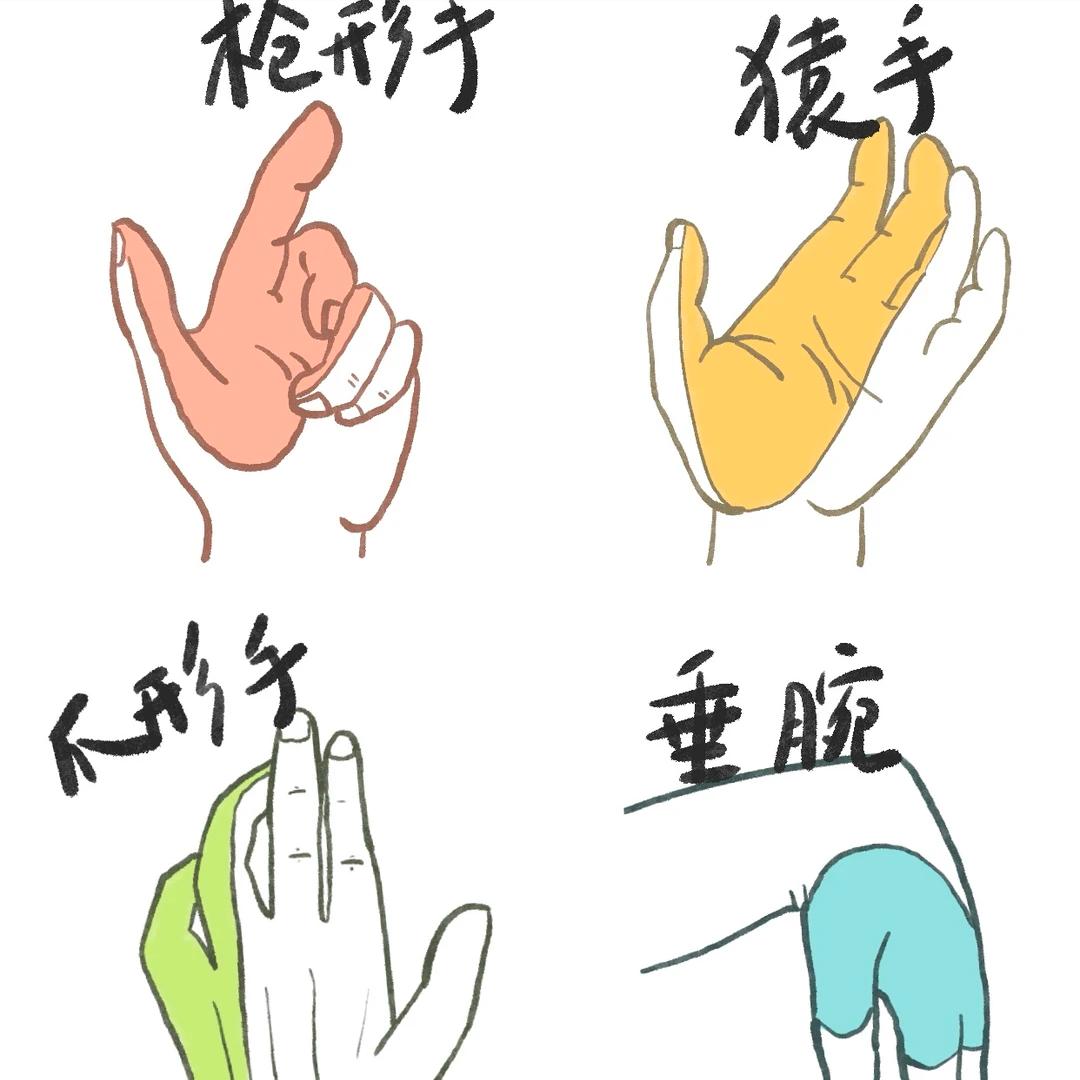 这4种“怪姿态”竟是神经损伤！拖久了可能致残！  1.正中神经损伤——猿