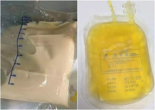 浙江女子长期吃外卖, 血浆变色“猪油膏”险死