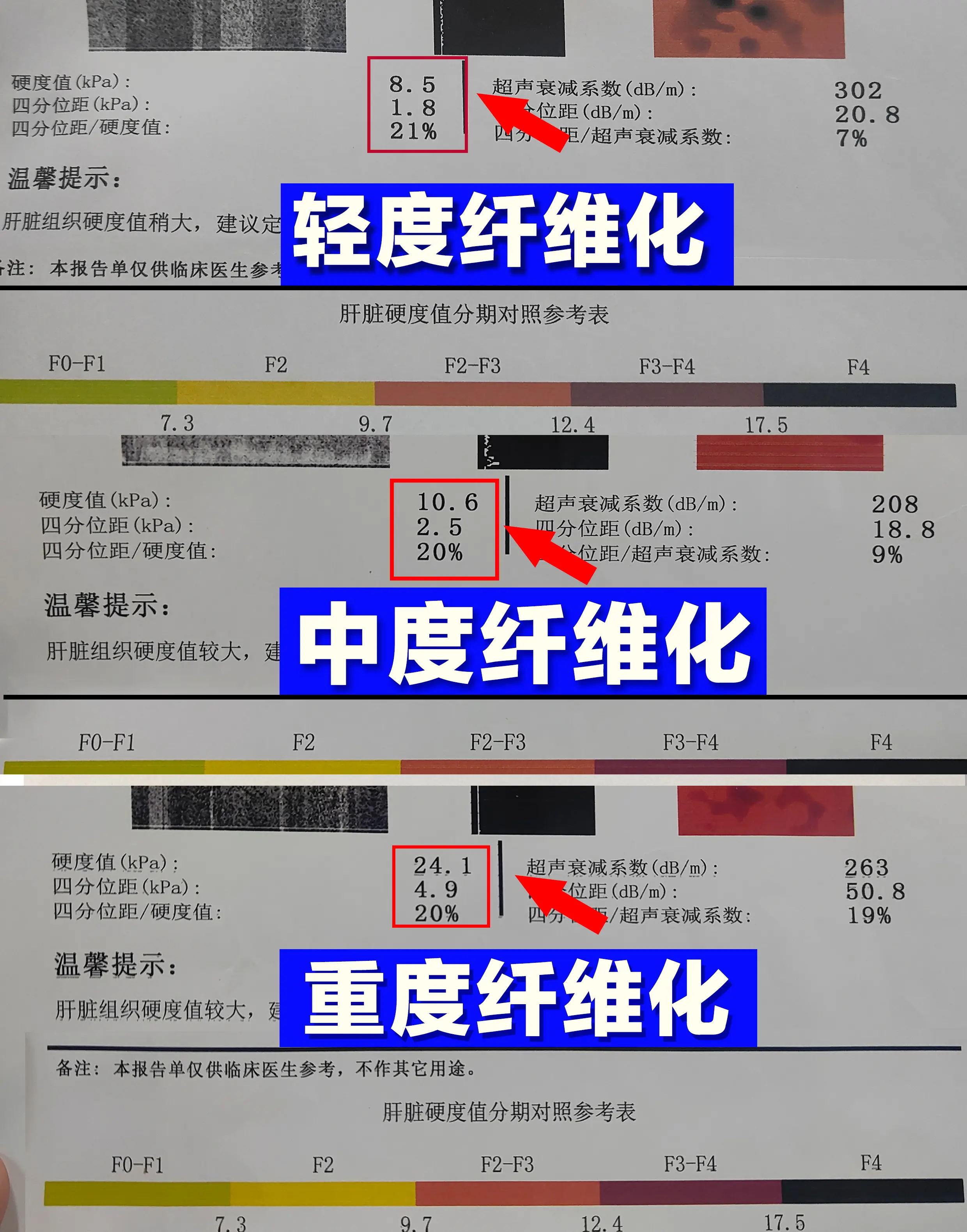 最近有朋友拿到肝脏弹性检测报告单，表示看不懂kPa数值，不知道自己纤维...