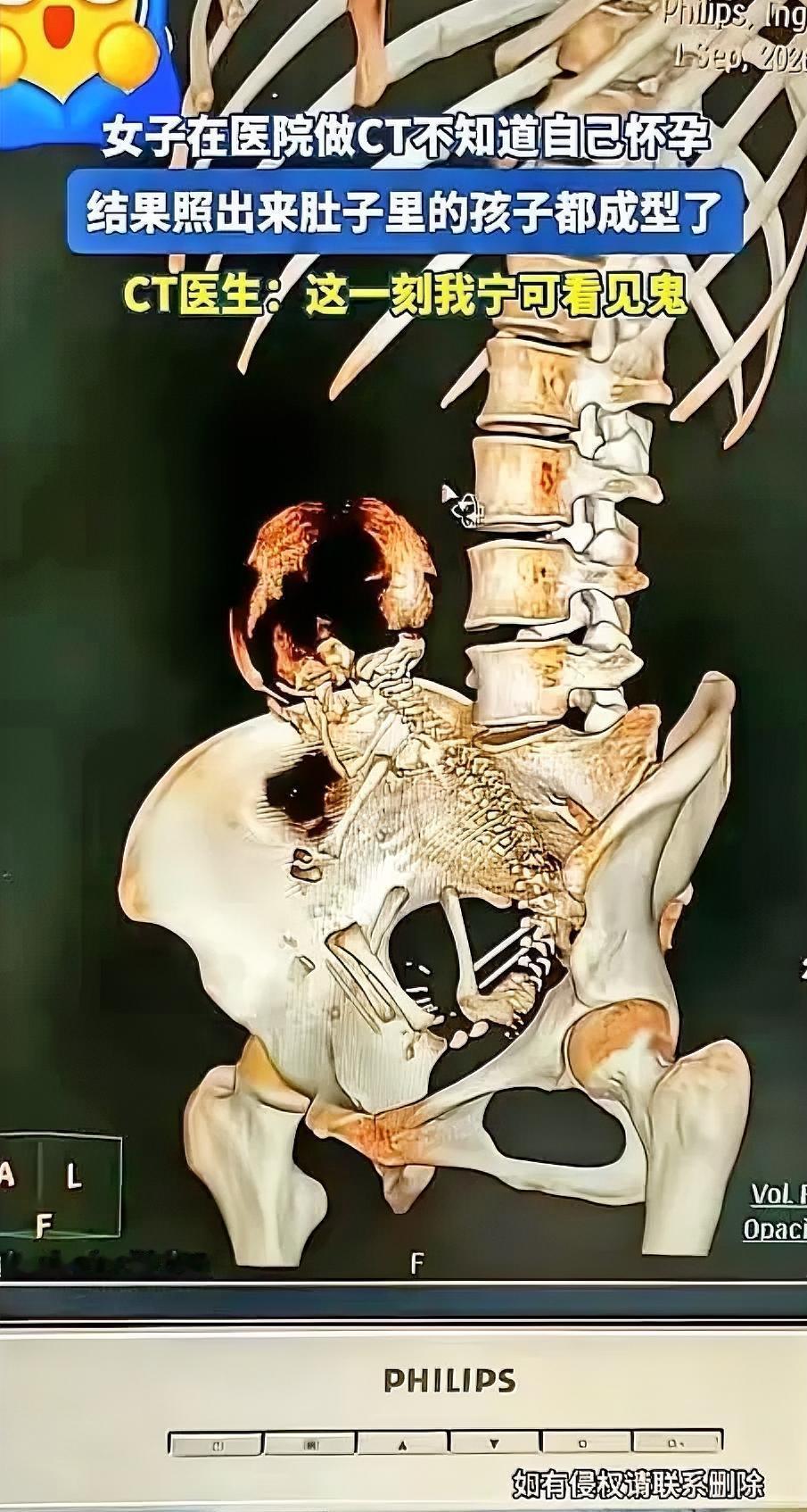 看得人手心直冒汗！有位孕妇自己完全没察觉怀孕，稀里糊涂就去做了CT，等片子出来医