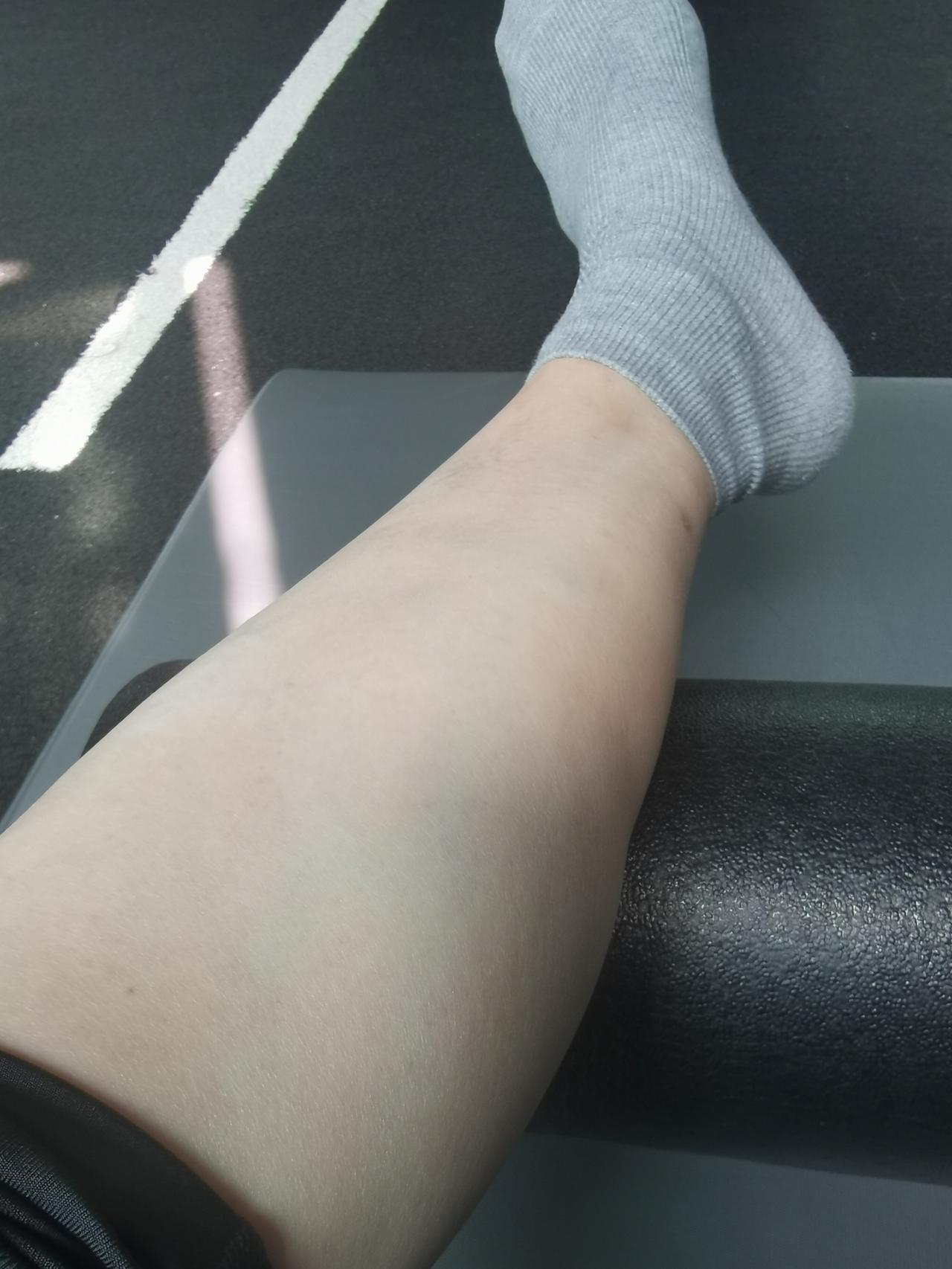 自从和医生说放弃治疗，我就照着医生的话，注意饮食。可白癜风的忌口太多了，这也不能