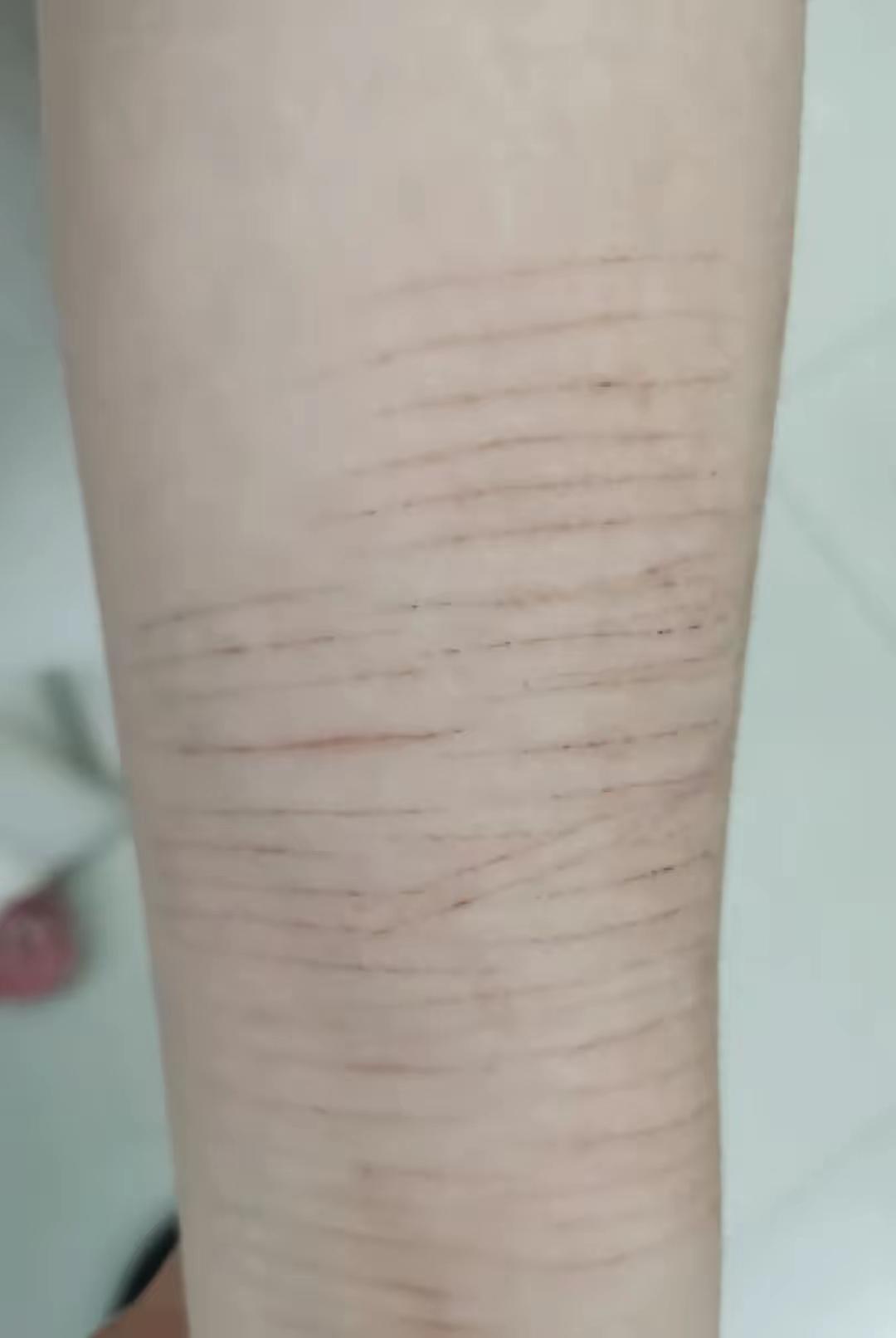 胳膊上爬满新旧划痕，14岁女孩拼命遮掩，老师急到主动陪诊，家长却一脸不屑：能吃能