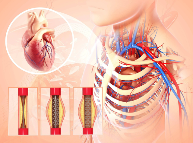 支架手术后戒烟戒酒, 不到2年再次心梗? 医生说出了3个原因