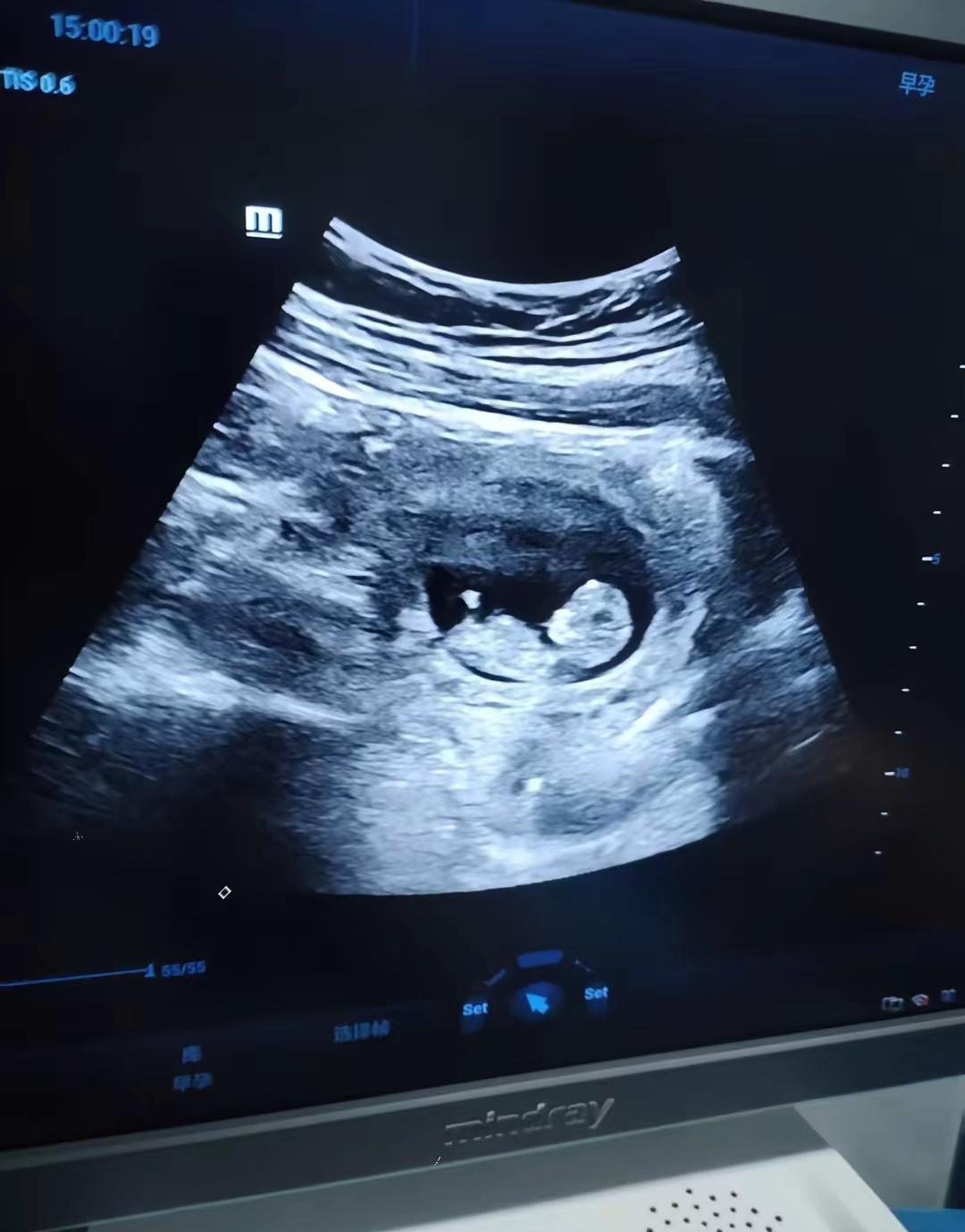 昨天陪老婆去产检，趁她出去拿报告，我偷偷问医生：男孩还是女孩？​医生头都没抬，