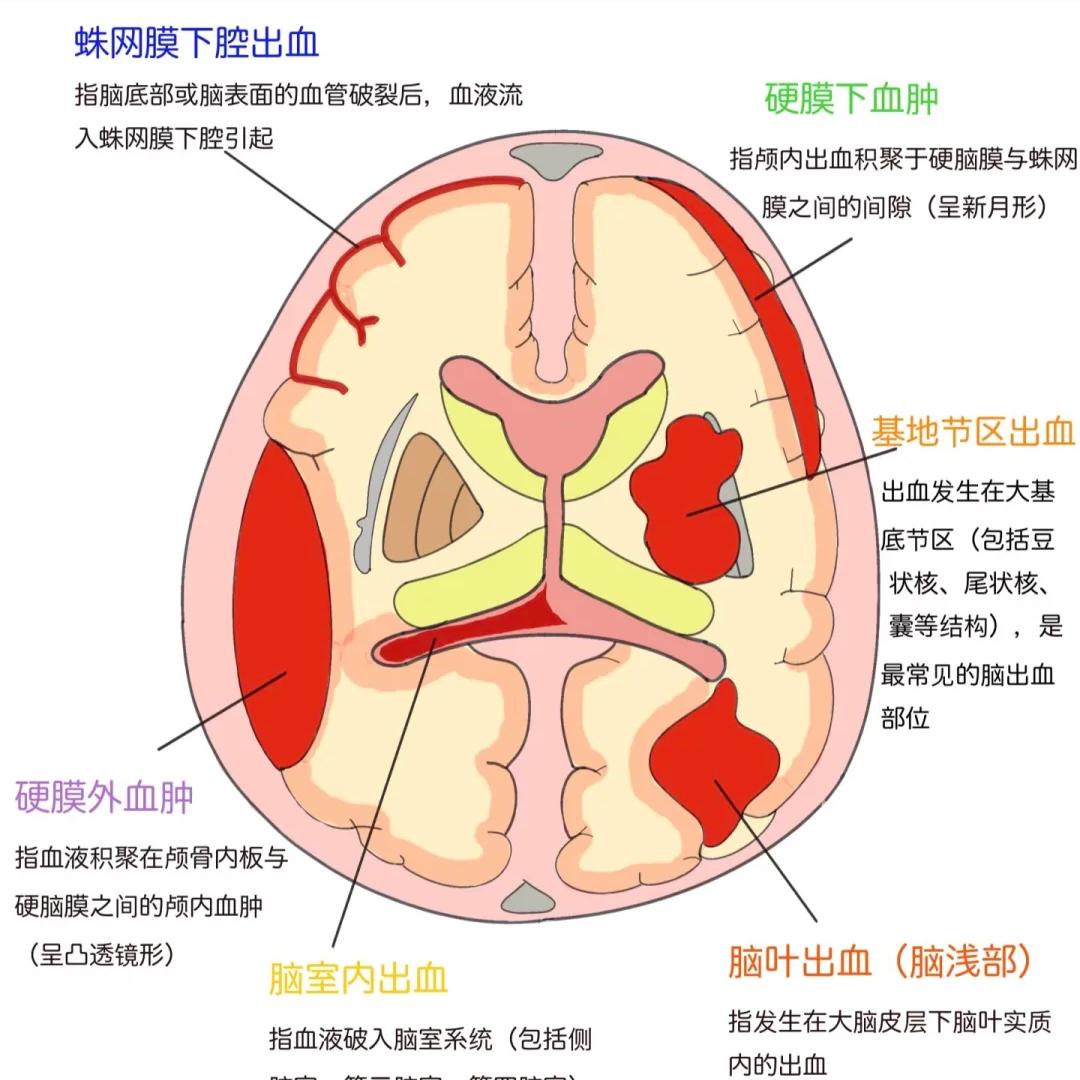 脑出血走错一步，就没了退路！这些错误不要再犯了 1.危险期急于求成、过度关