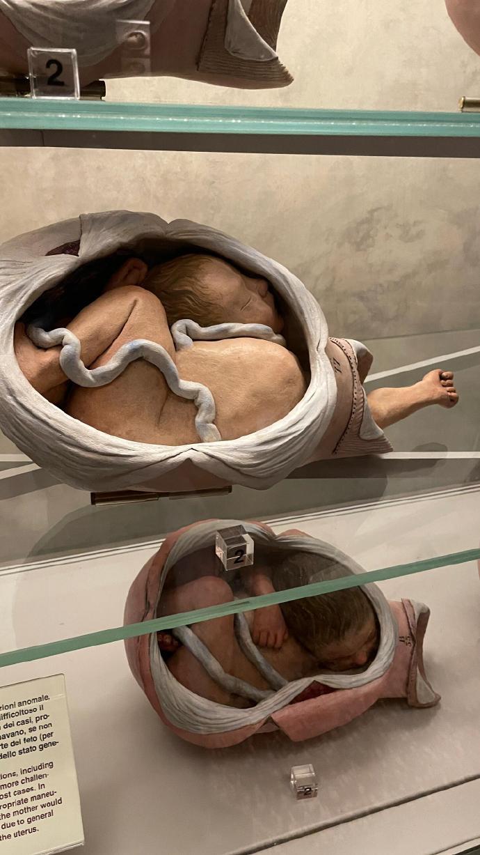 胎位不正好吓人啊