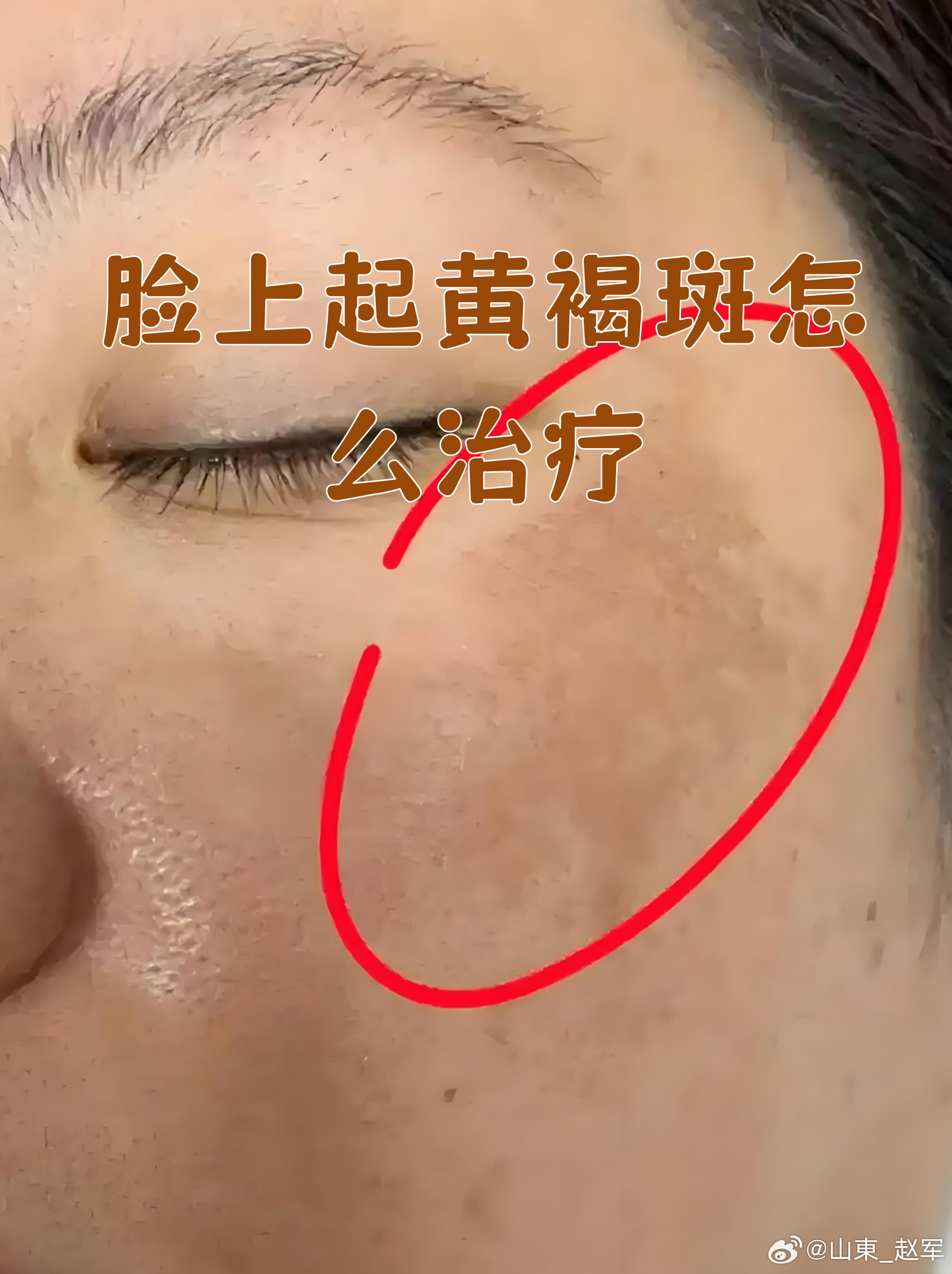 黄褐斑外治方看到《中医外治杂志》，2000年第5期记录的一个治黄褐斑的方子。【