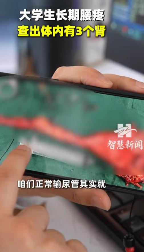 “真是开眼了！”7月23日报道，陕西，一小伙身体右侧偶尔腰痛、腹痛，在学校检查时