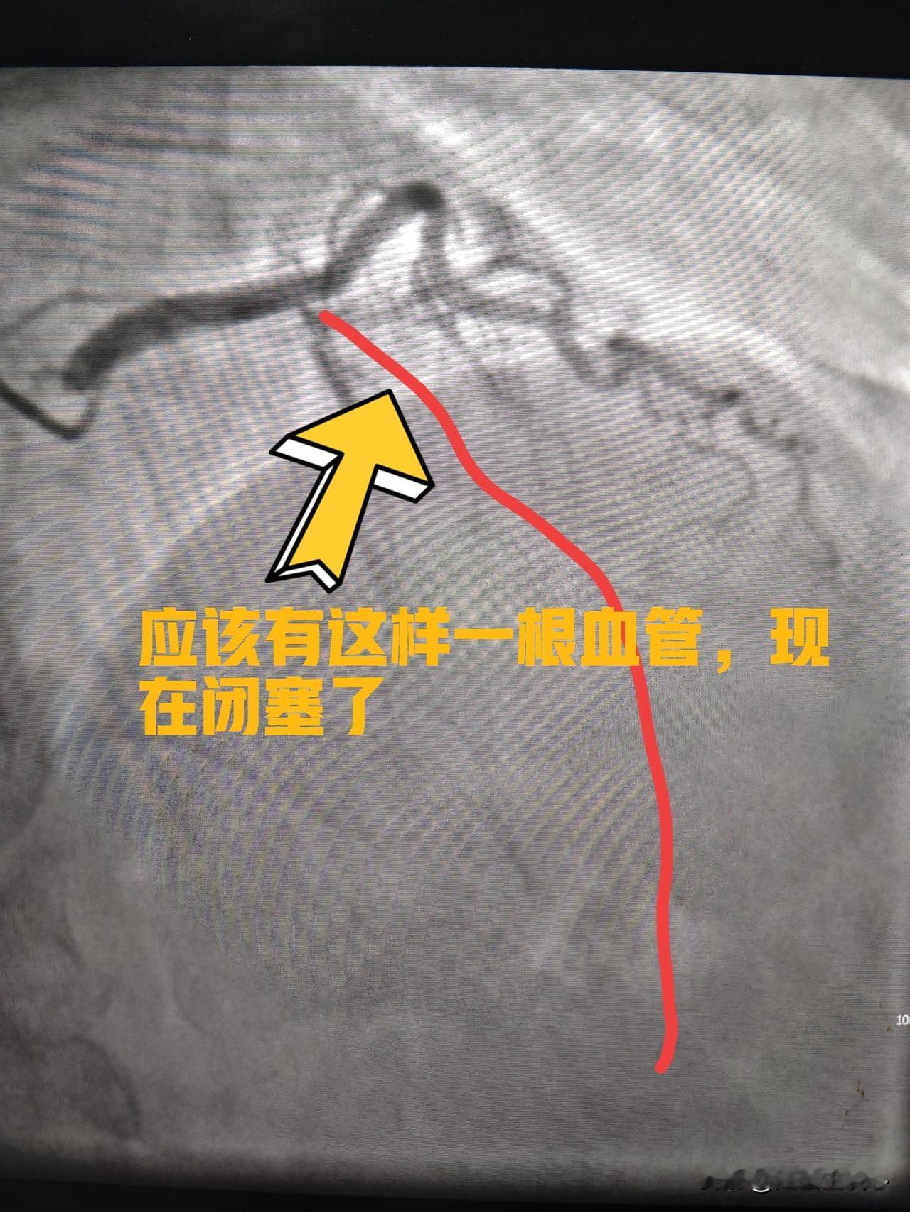 冠脉闭塞病变开通又一例66岁男性患者，间断胸闷1年，开始以为是胃病