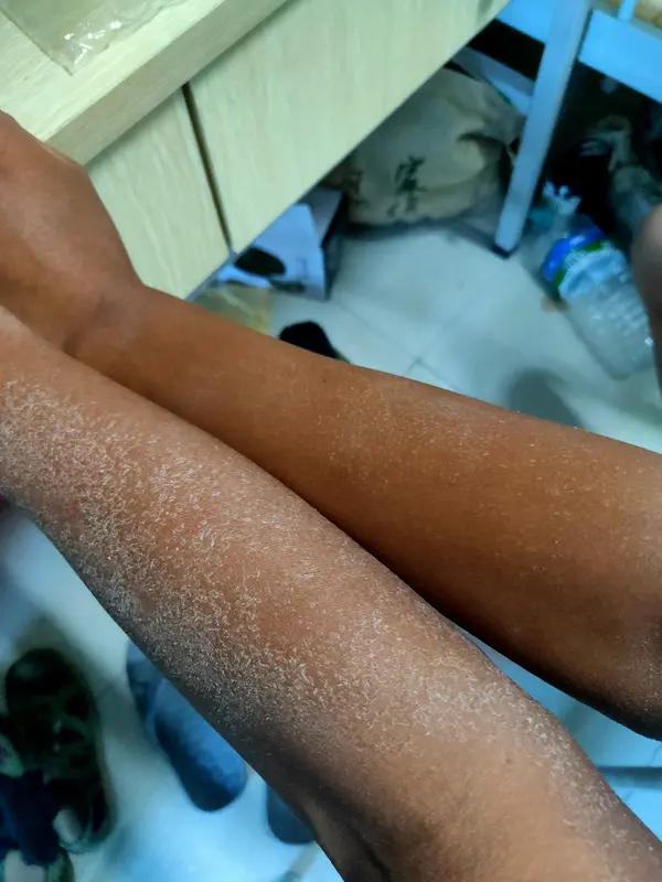 晒黑后为啥迟迟没能白回来？普通晒黑只是紫外线刺激黑色素细胞活跃引