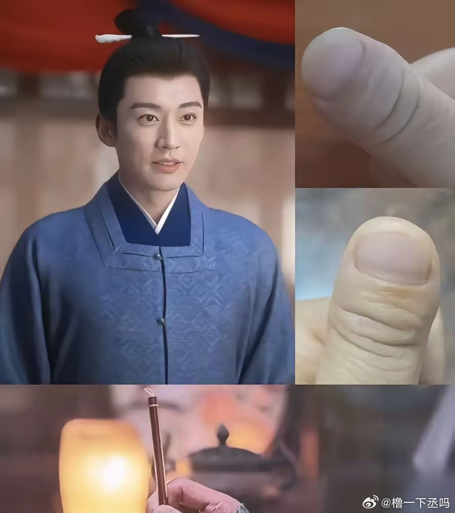 刘学义这手，一伸出来，弹幕直接炸了。拇指短粗，指甲盖又扁又平，末端像个小鼓槌。医生管这叫杵状指。网友
