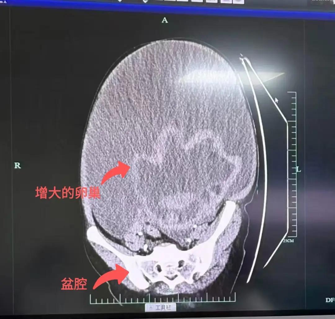 “太吓人了！”浙江湖州，一40多岁的女服务员体重近180斤，因常年肚子大被家人误