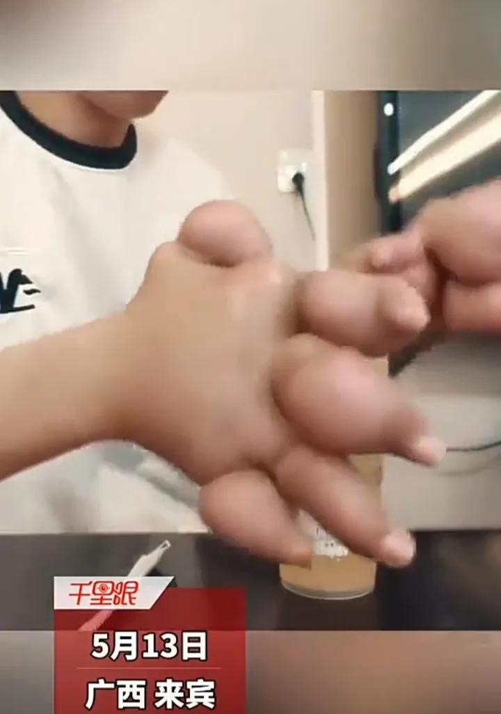 看完被震惊了！5月13日，广西来宾一名男子发视频称，自己二十多岁就患上了痛风，双