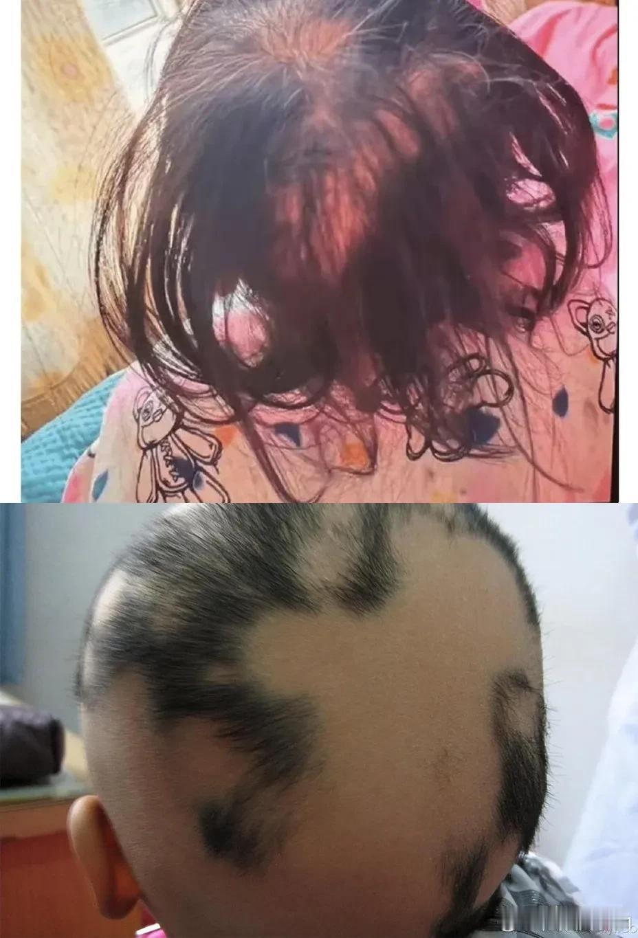 湖南3岁女孩铊中毒，调查结果出来，是人为投毒！刘女士的女儿，不明原因眼神呆滞、走