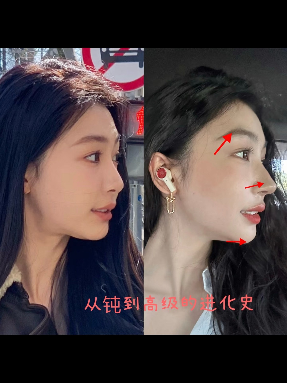 曝易梦玲整容刷到易梦玲那个下巴对比图了，有人说用的是peek材料，这也太具体了吧