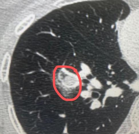 肺磨玻璃结节随访期间，发生转移了？跟大家分享一个我接诊过的病例，有位60多岁的阿