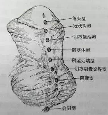 男子从小蹲着尿, 发现无法行房后紧急求医! 医生: 每300个男孩就有1个中招