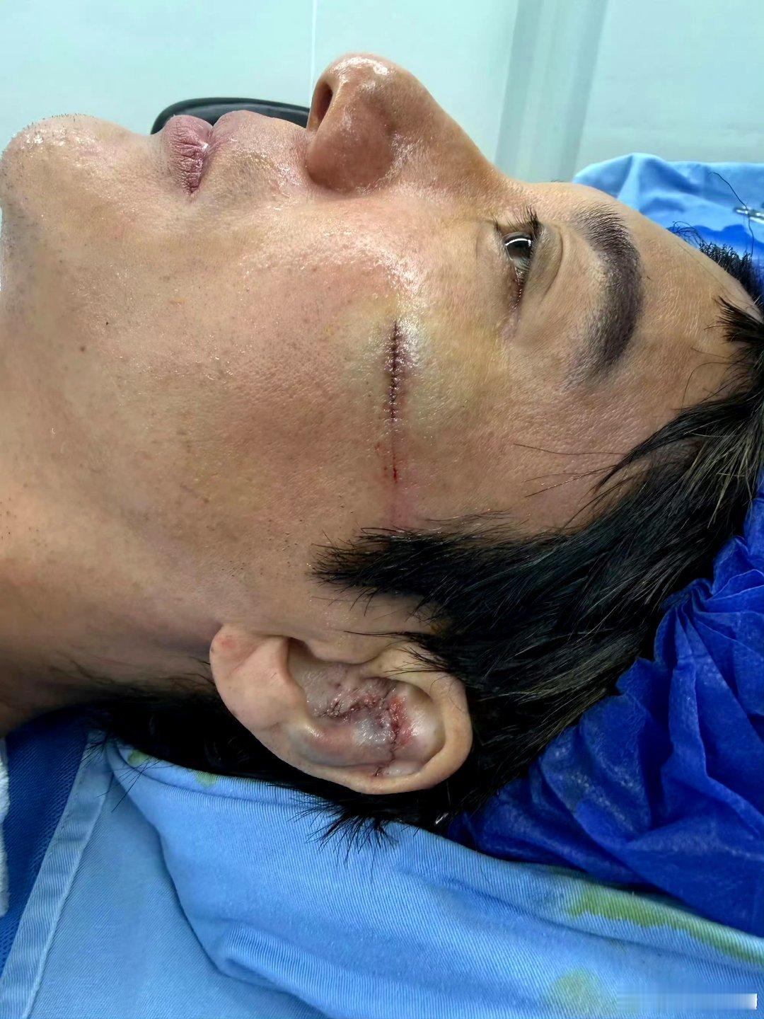王力宏缝了39针太吓人了，这样严重的伤居然还坚持了那么久，哥还是太敬业了，工作人