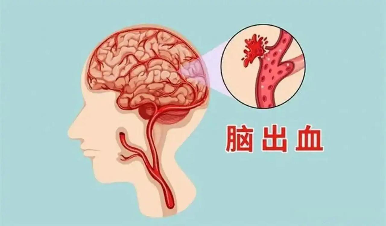 越来越多的人脑出血去世！医生含泪苦劝：这些事，再发也要戒掉 上周刚送走个42