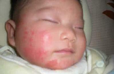孩子湿疹闹情绪时 该怎么帮宝宝度过湿疹带来的瘙痒?