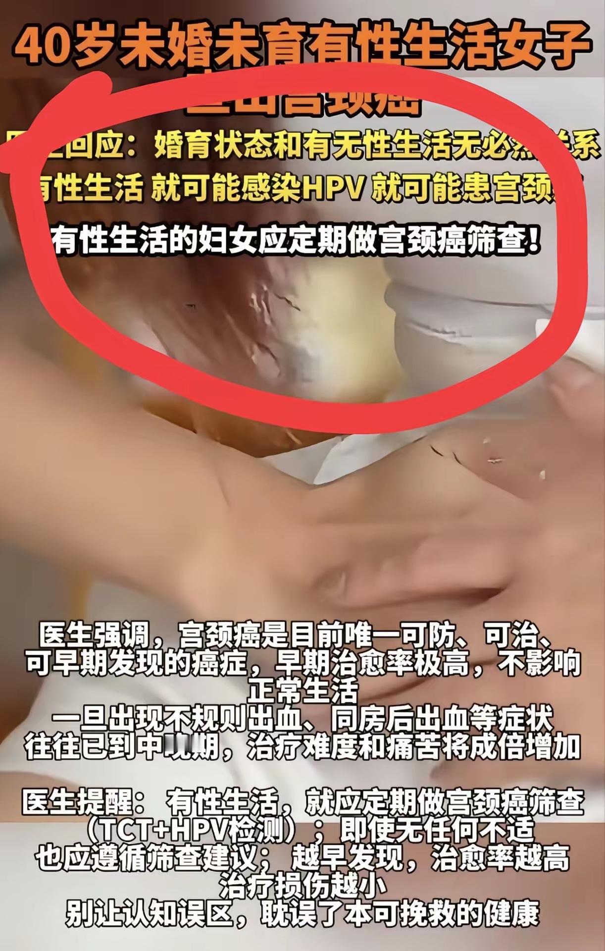 4月，浙江杭州40岁未婚的王女士，突感下体不适，去医院一查，确诊宫颈癌中晚期！原