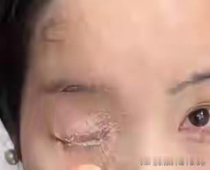 近日，贵阳何女士用502胶水贴指甲片时不慎打翻，胶水喷溅致眼睛、鼻孔被粘，经历近