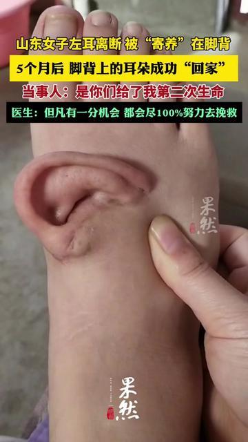 你见过脚背上长耳朵吗？山东一位大姐的左耳，居然在脚背上住了5个月！去年她