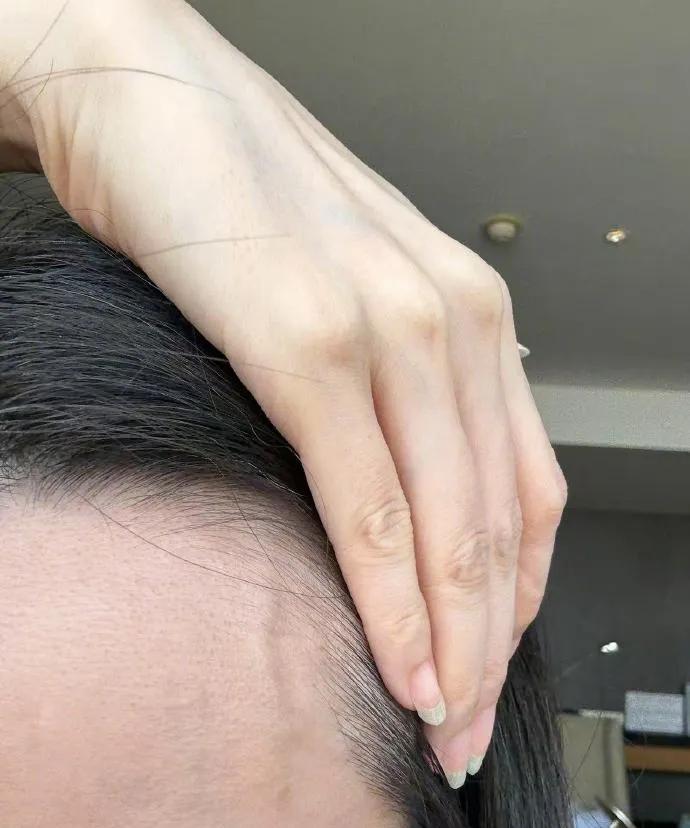 张靓颖自曝近况：额头血管偶突起、手掌伸懒腰会流血，体检出风湿性免疫力低下还营养不