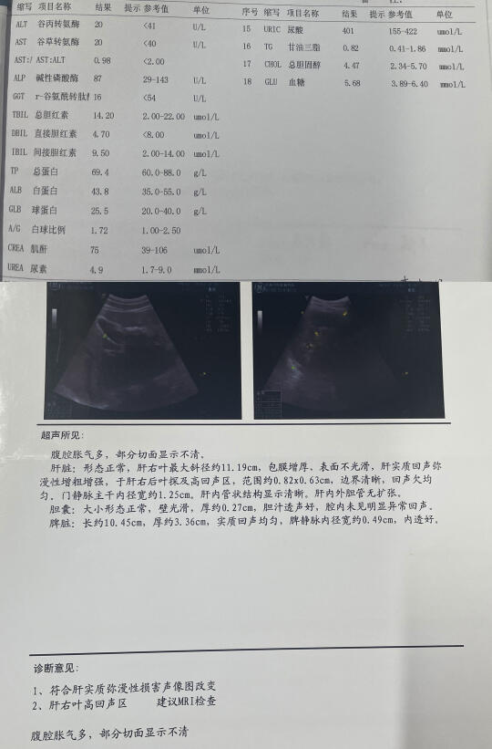 乙肝临床治愈是唯一治疗的目标吗？很多患者因为这个误区错过了好的预后，下...