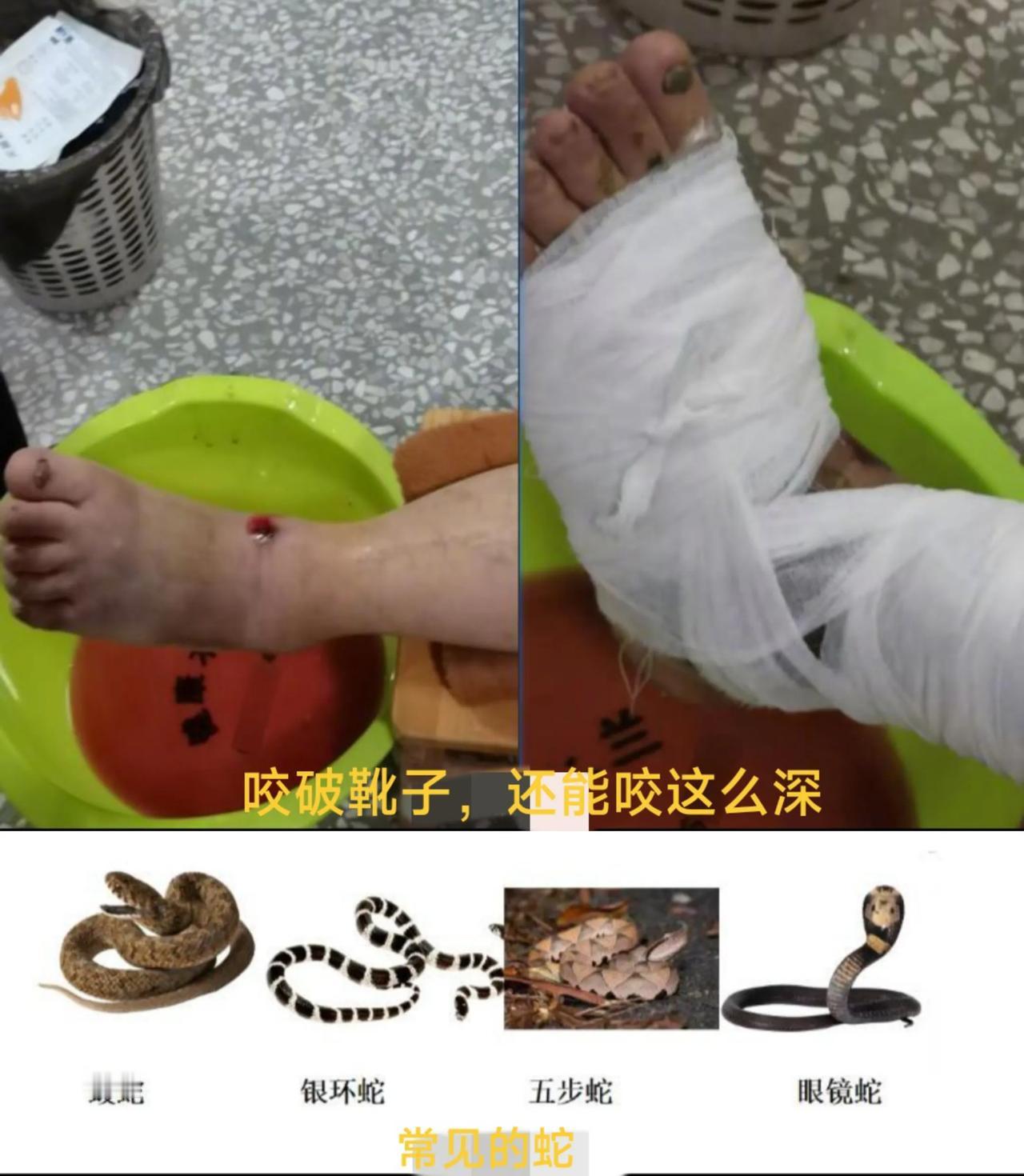 这蛇真的太可怕了，穿着高筒雨靴都能咬到！伤口瞬间肿胀，流血不止！这是近日发生