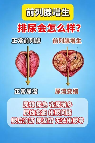尿频夜尿多、尿流变细，警惕前列腺增生的信号