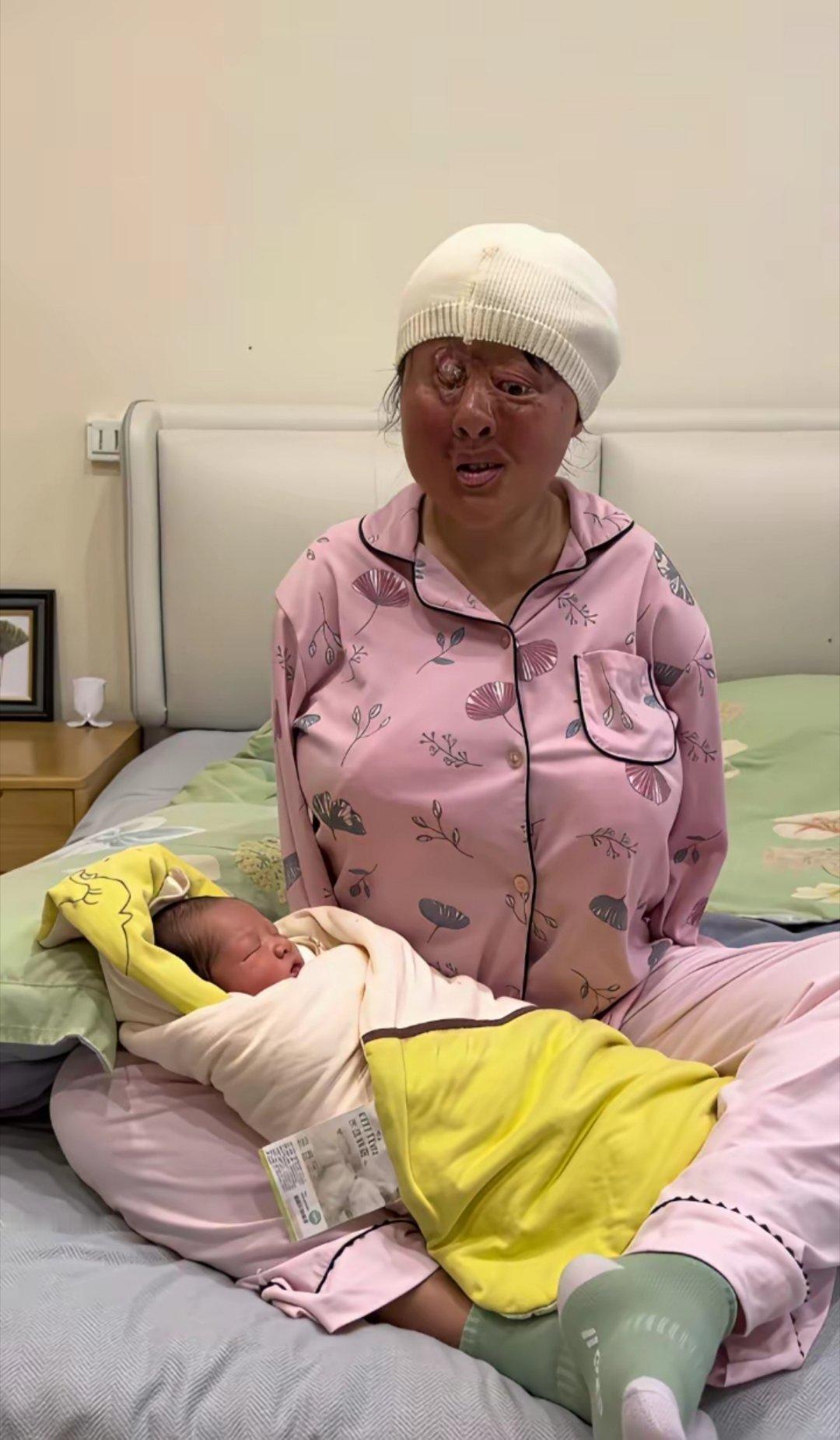 无臂女士雷丹丹生二胎了！佩服她的勇气和毅力！她幼时被雷电击中失去双臂，又毁容，我