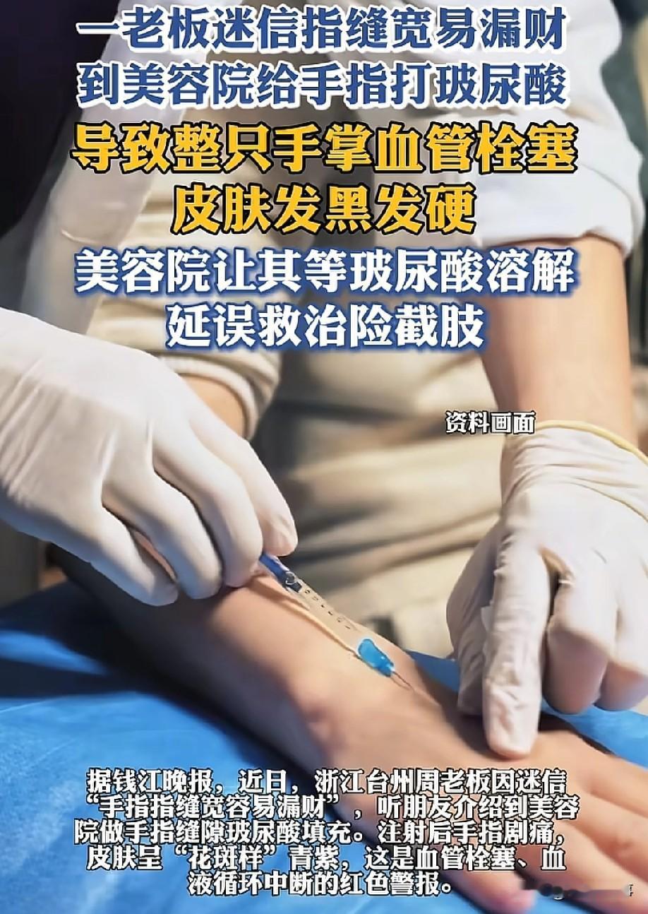 哭笑不得！5月27日，据台州晚报报道，浙江台州一位周老板为了“聚财”，往手指缝里