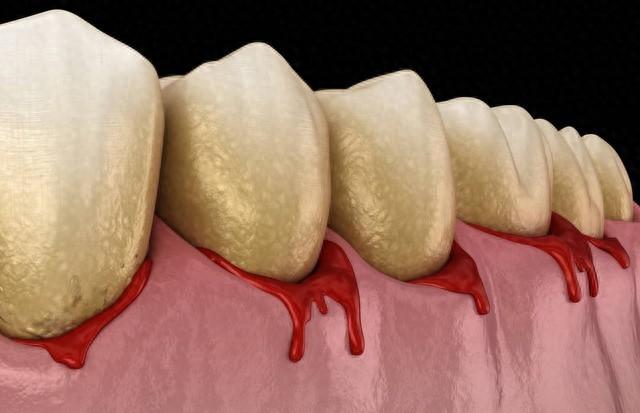 牙疼，多半由这3种问题引起！确定了病因，彻底远离并不难牙疼来得总是毫无征兆，