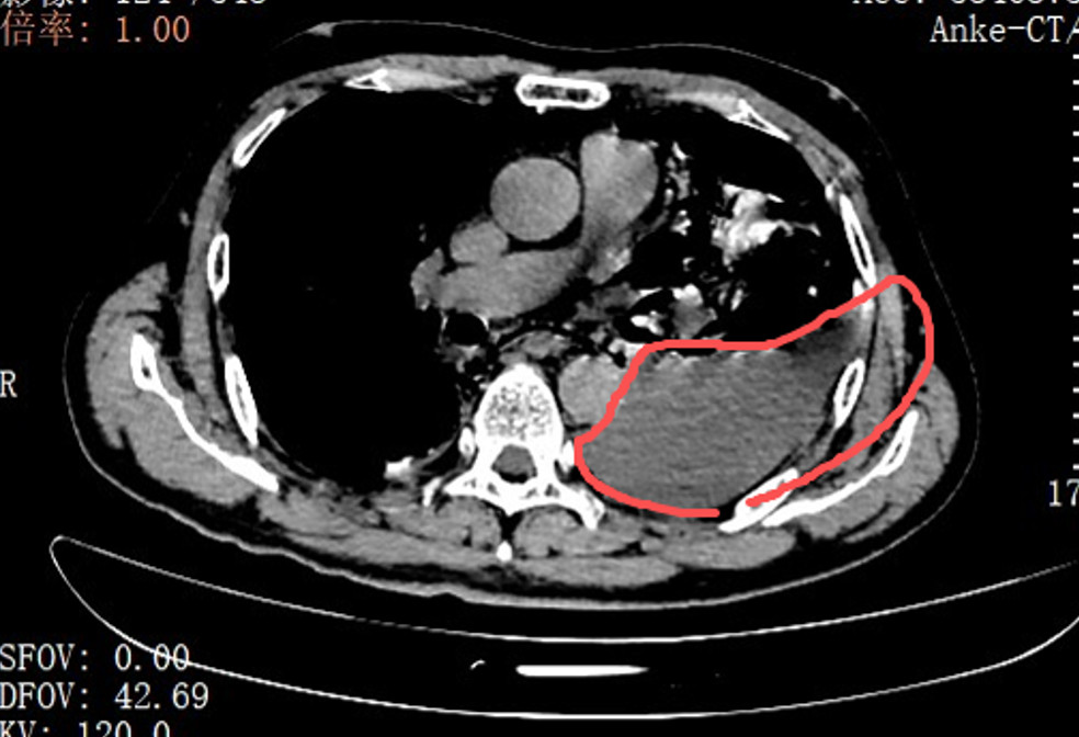 两个叉烧包险些要命！男子胸腔漏出剩菜渣，食道裂10公分
