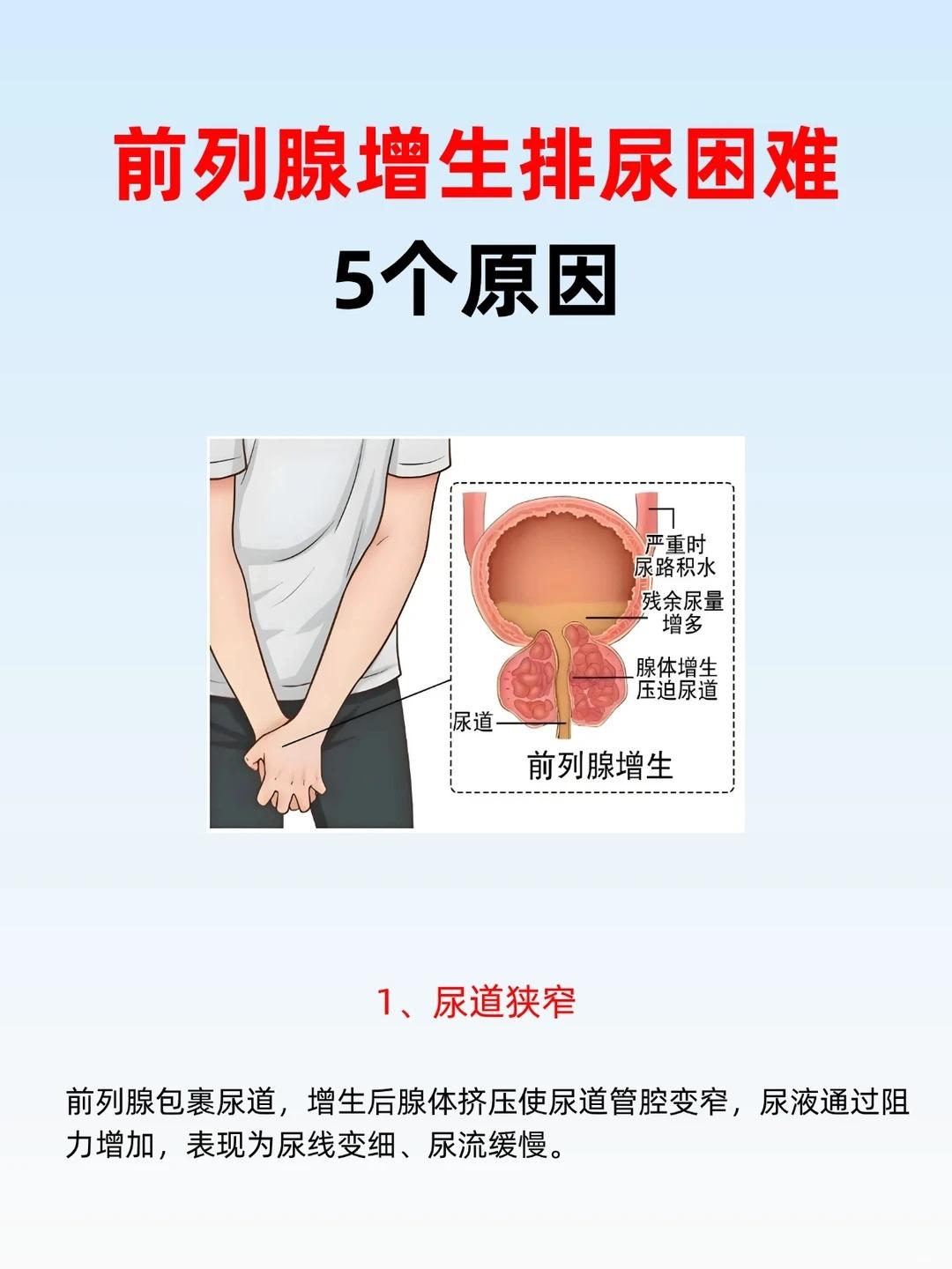 前列腺增生导致排尿困难的5个原因！