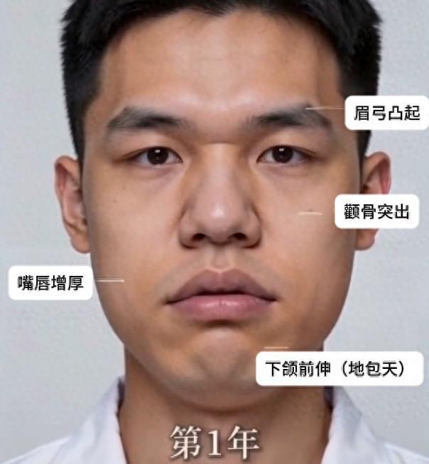 不可思议！浙江台州，一女子陪弟弟去医院看病，接诊医生偶然注意到她眉弓凸出、鼻翼增