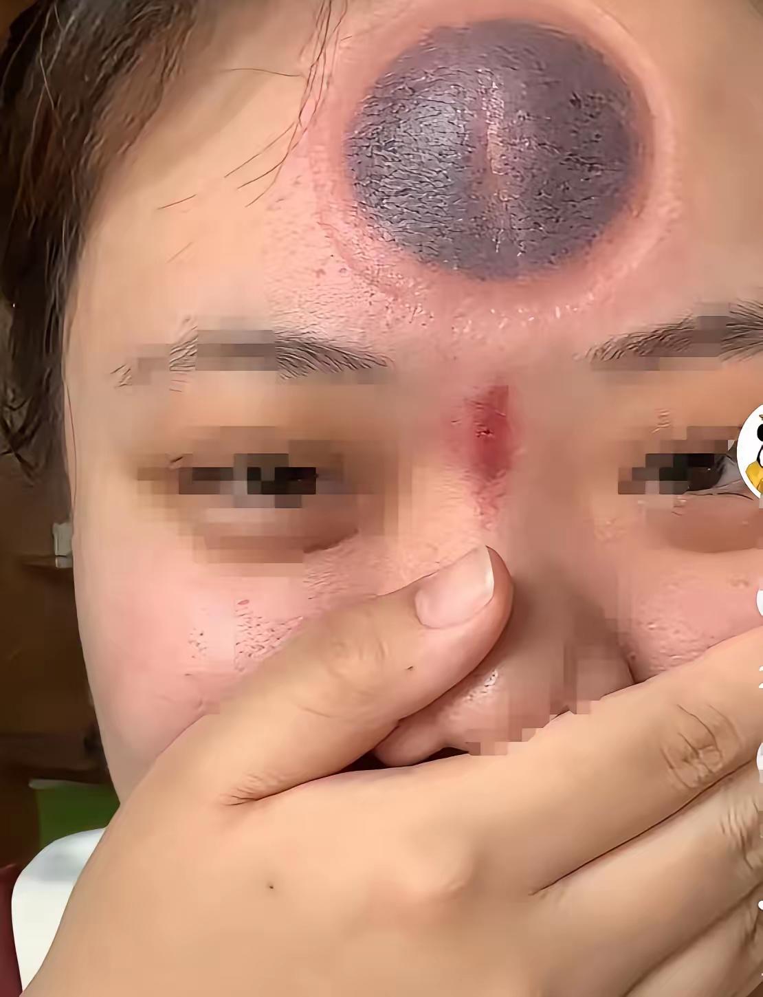 在网上刷到一位女子，由于她经常头疼，据说是进风了，于是她就在网上买了一些拔罐的工