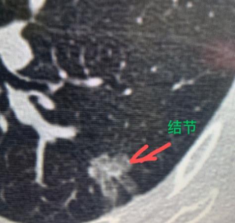 经常“拉肚子”，一查竟是肺癌......广州53岁的王姐可能怎么也想不到，自己竟