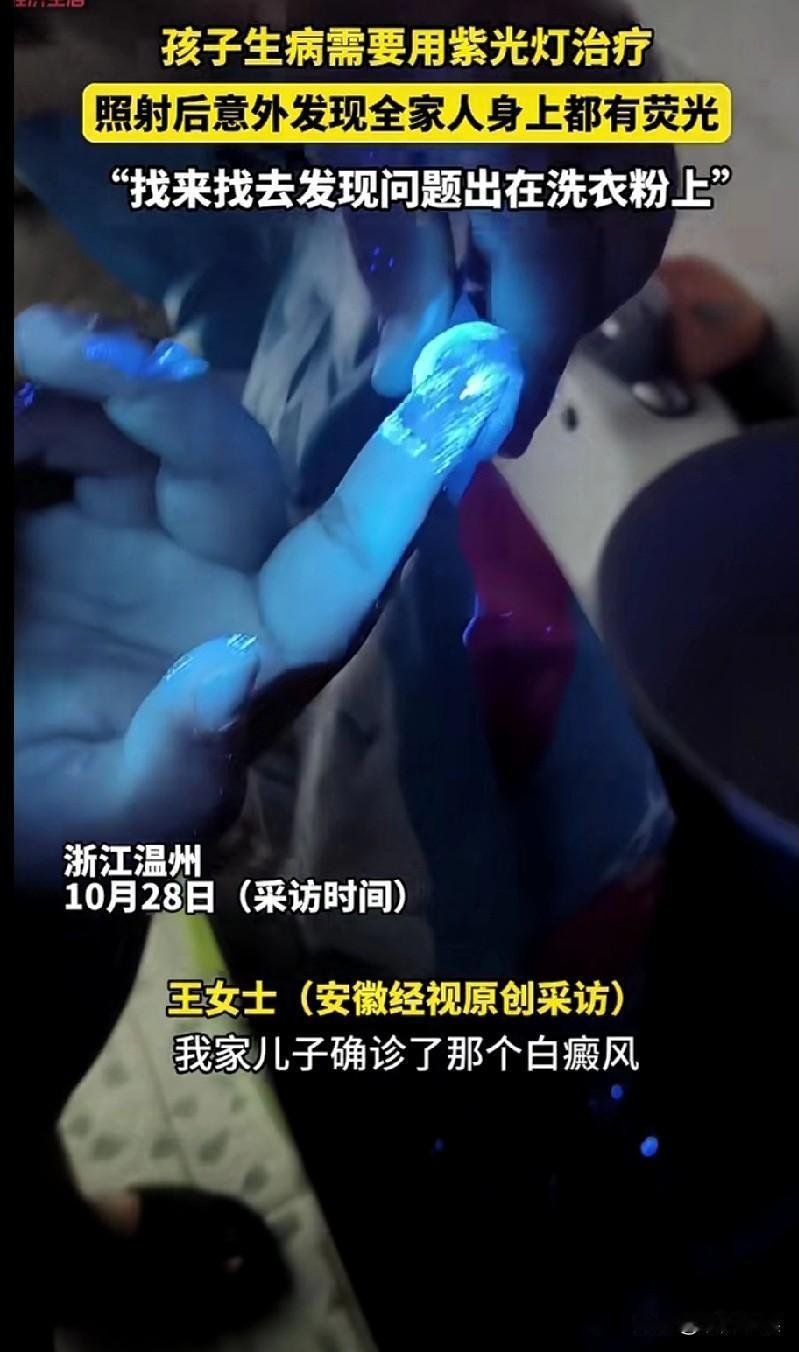 洗衣粉有荧光!?浙江温州王女士的孩子在医院确诊了白癜风,医院给孩子开了一个紫光灯