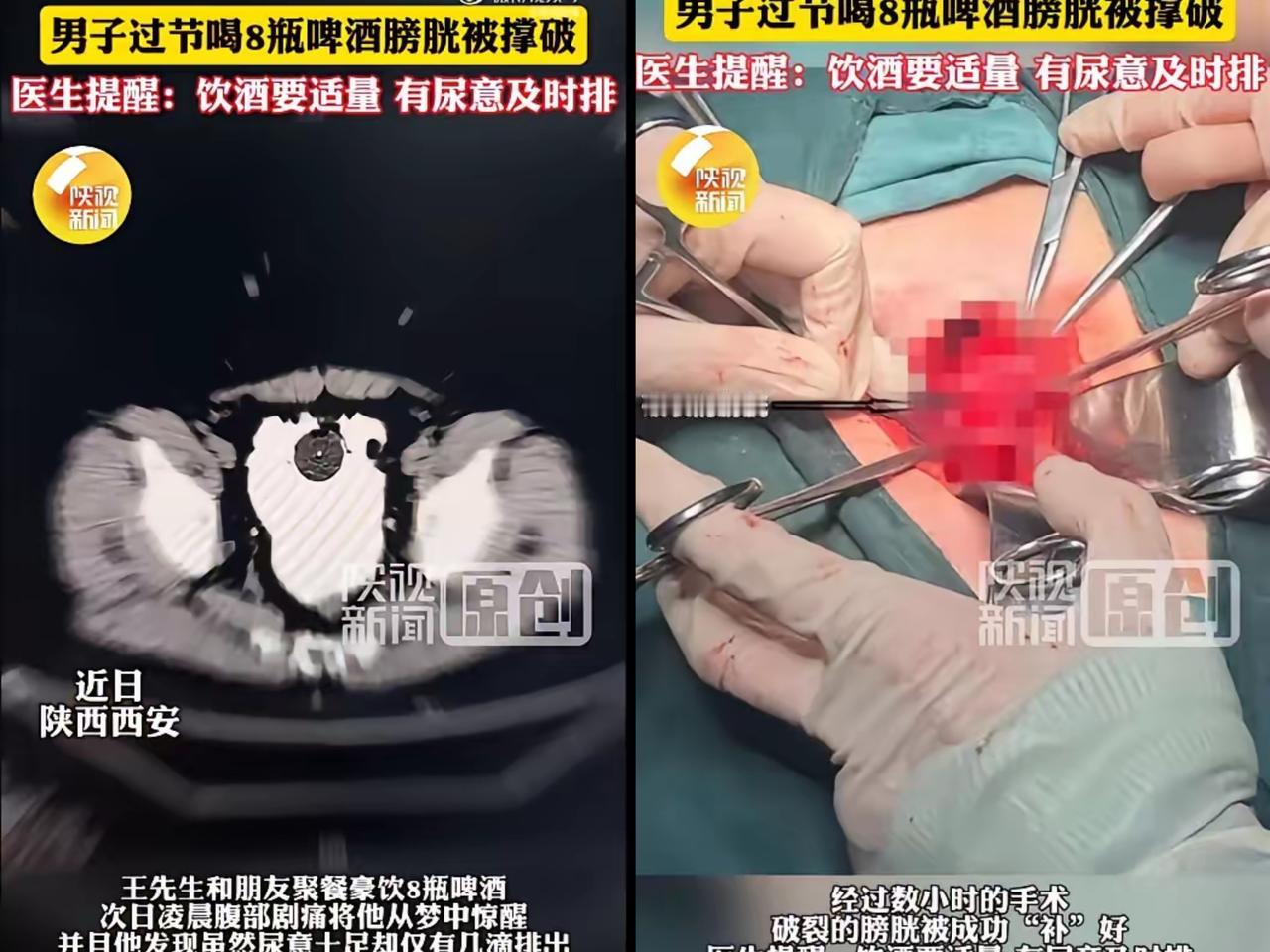 喝8瓶啤酒没上厕所，膀胱直接裂个6cm大洞！这习惯你可能也有谁能想到，喝顿