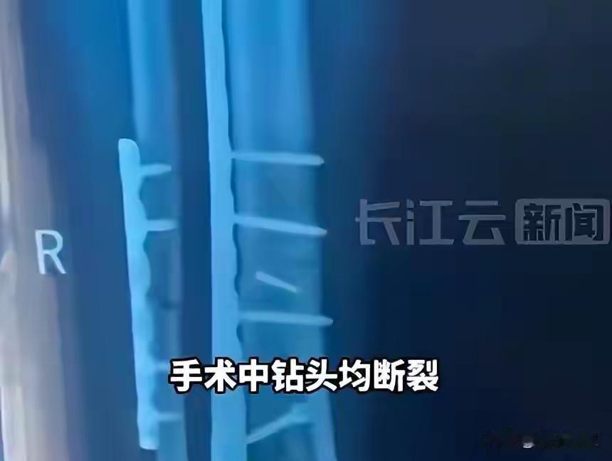 医院的这种说法真的是滑天下之大稽。将钻头遗落在患者体内，居然轻描淡写地认为“影