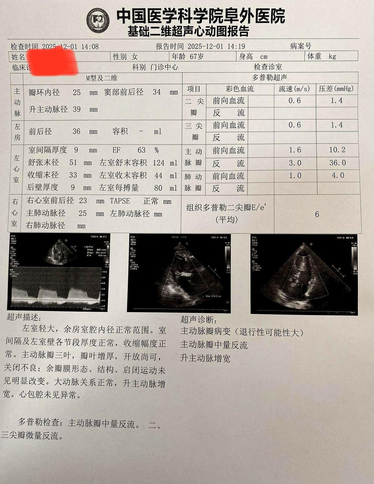 刚刚拿到阜外医院的彩超结果，左心室51mm。医生看到结果的第一句话是“做吗？”